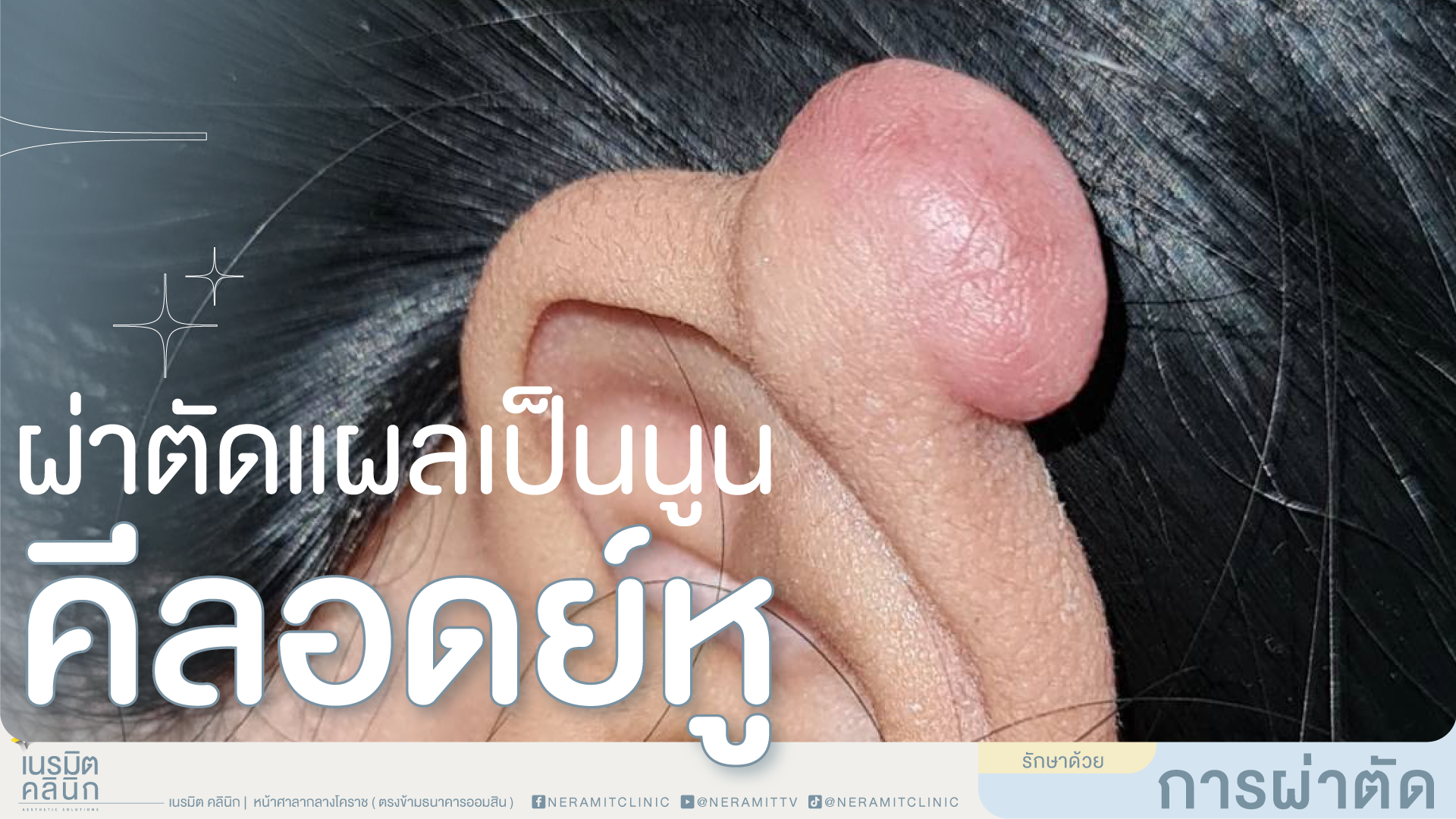 ภาพแสดงลักษณะของแผลเป็นนูน หรือคีลอยด์ขนาดใหญ่บริเวณใบหูส่วนบน ก่อนเข้ารับการผ่าตัดรักษาที่เนรมิตคลินิก