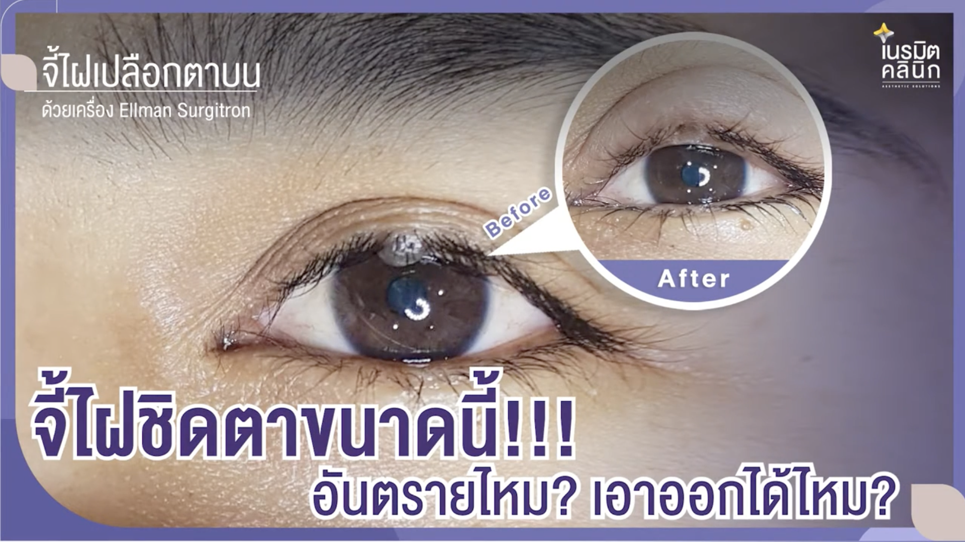 ภาพเปรียบเทียบก่อนและหลังการจี้ไฝเปลือกตาบนบริเวณชิดโคนขนตา ด้วยเทคโนโลยีเครื่อง Ellman Surgitron ที่เนรมิตคลินิก