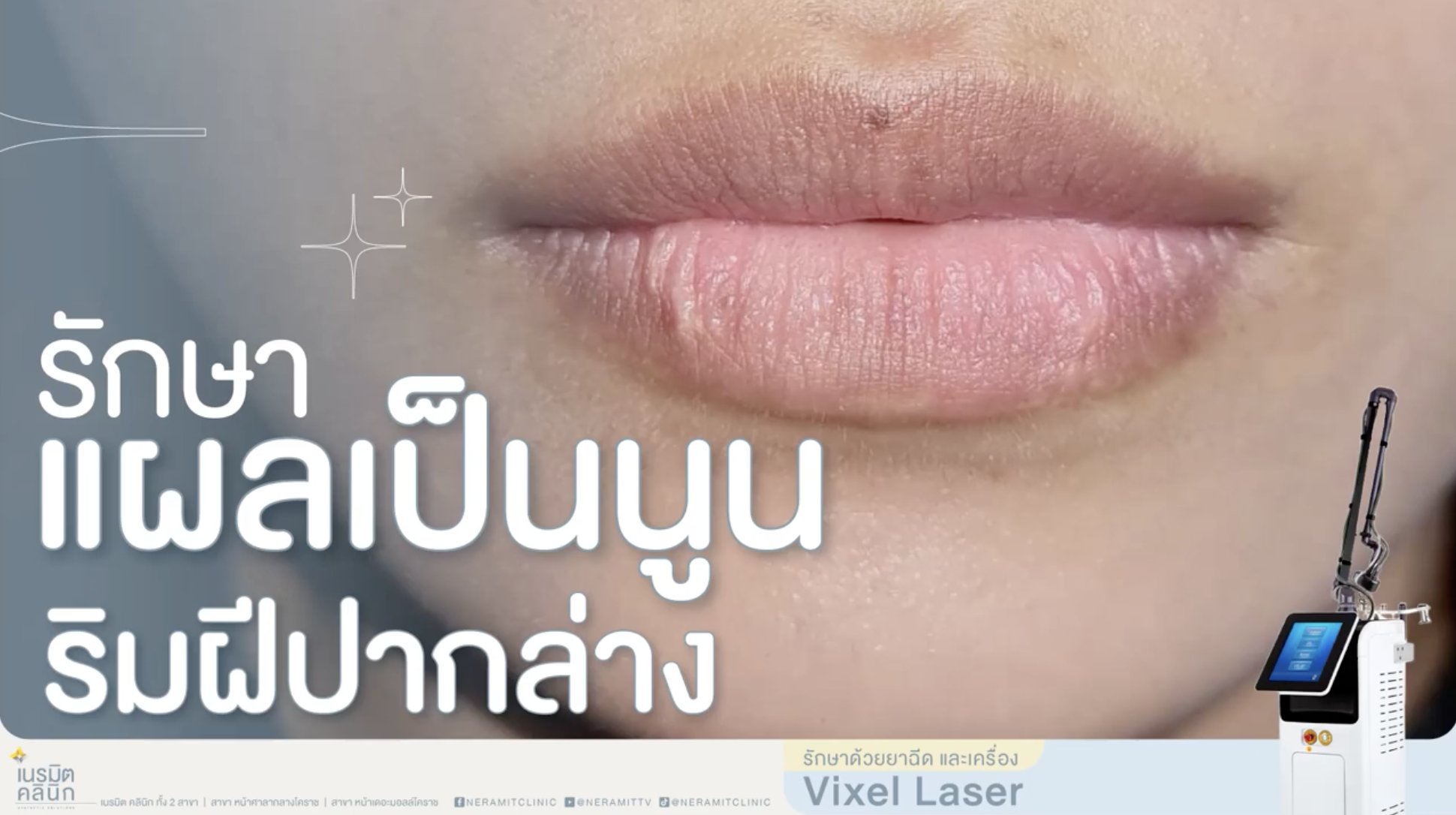 รีวิวผู้เข้ารับการรักษาแผลเป็นนูนหรือคีลอยด์บริเวณริมฝีปากล่าง ด้วยการใช้เครื่อง Vixel Laser ควบคู่กับการฉีดยา