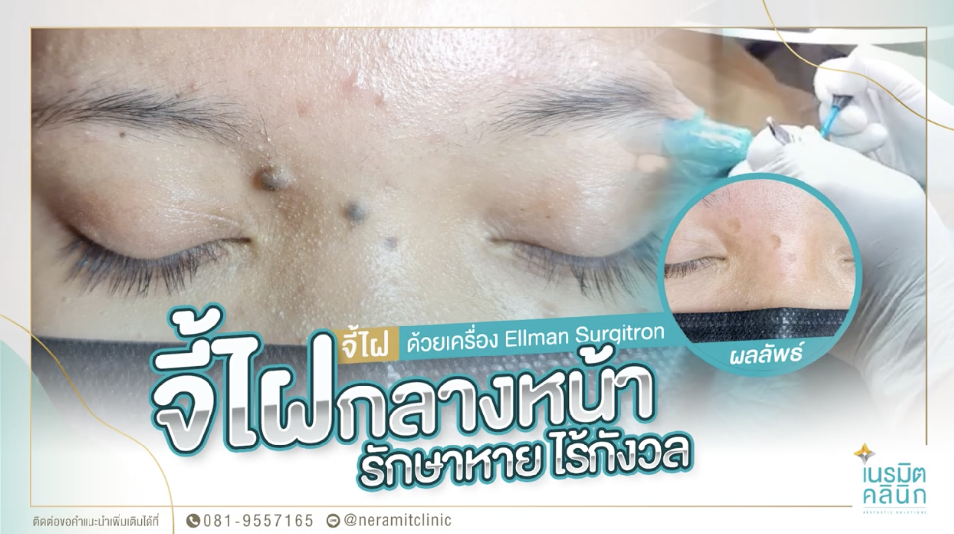ภาพเปรียบเทียบก่อนและหลังทำ แสดงผลลัพธ์การจี้ไฝกลางหน้าระหว่างคิ้วด้วยเครื่อง Ellman Surgitron ที่เนรมิตคลินิก