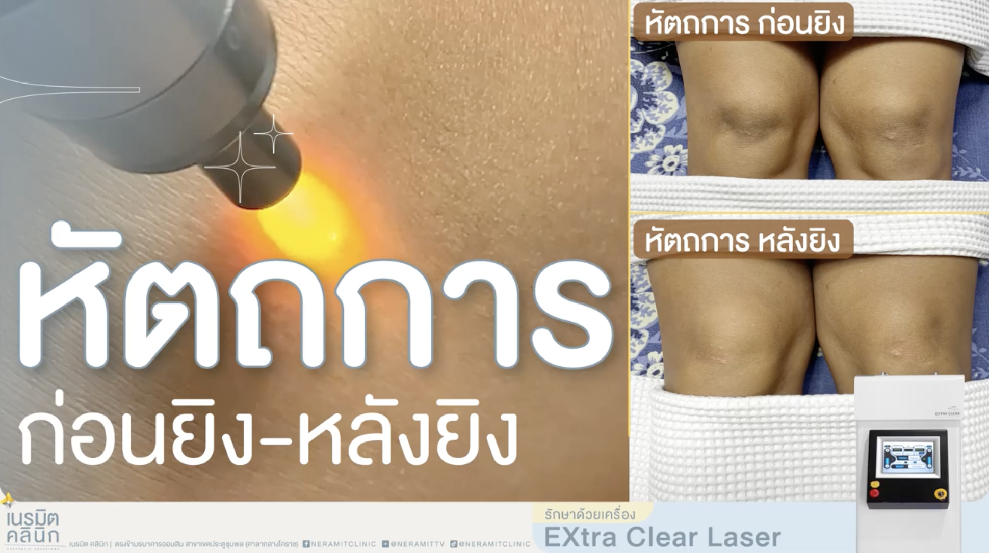 ภาพเปรียบเทียบก่อนและหลังทำหัตถการเลเซอร์แก้เข่าดำ เข่าด้าน ด้วยเทคโนโลยีเครื่อง Extra Clear Laser ที่เนรมิตคลินิก