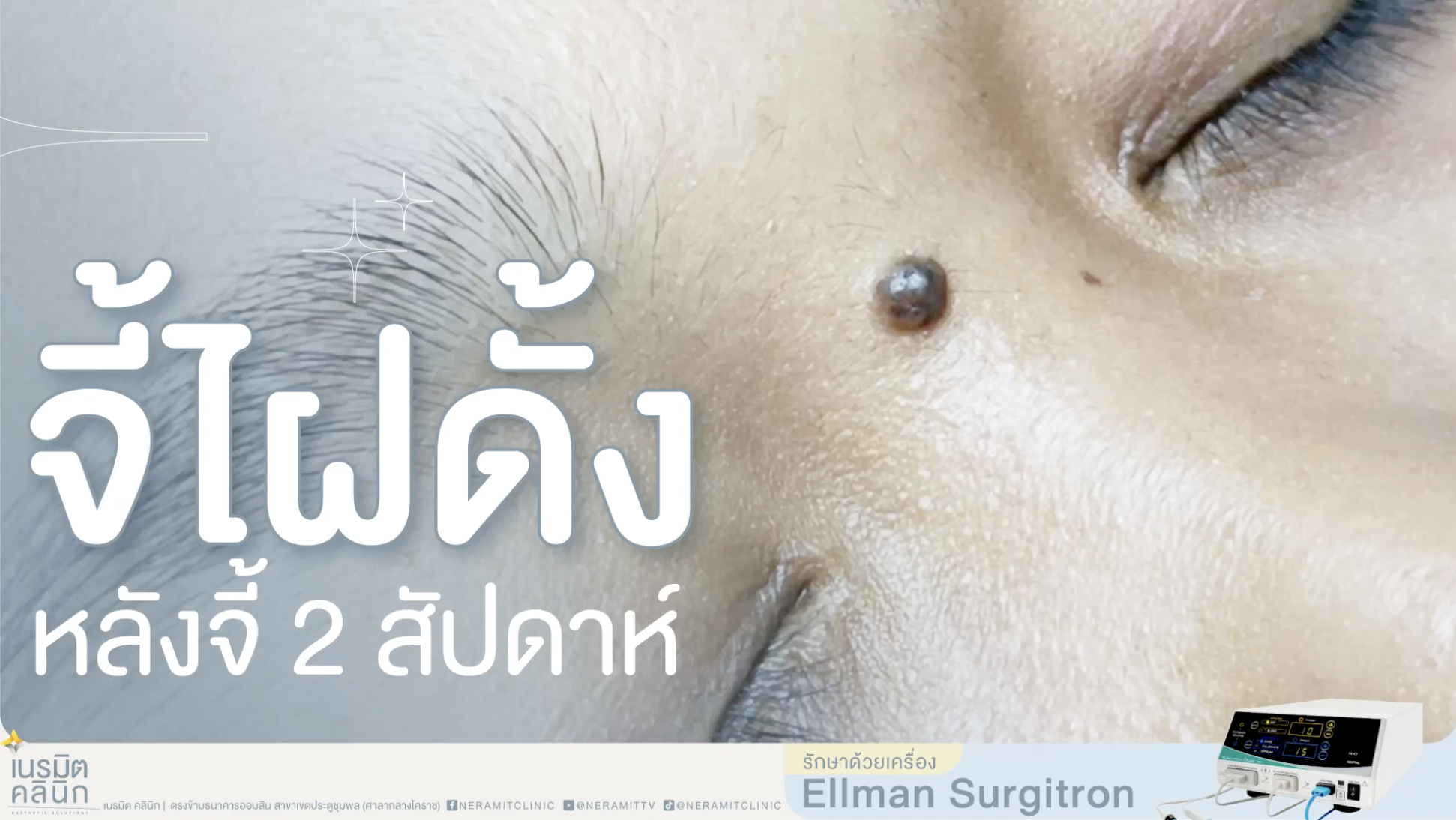 ภาพรีวิวผลลัพธ์หลังจี้ไฝดั้งผ่านไป 2 สัปดาห์ เผยให้เห็นรอยแผลที่สมานตัวและเรียบเนียน จากการใช้เครื่อง Ellman Surgitron