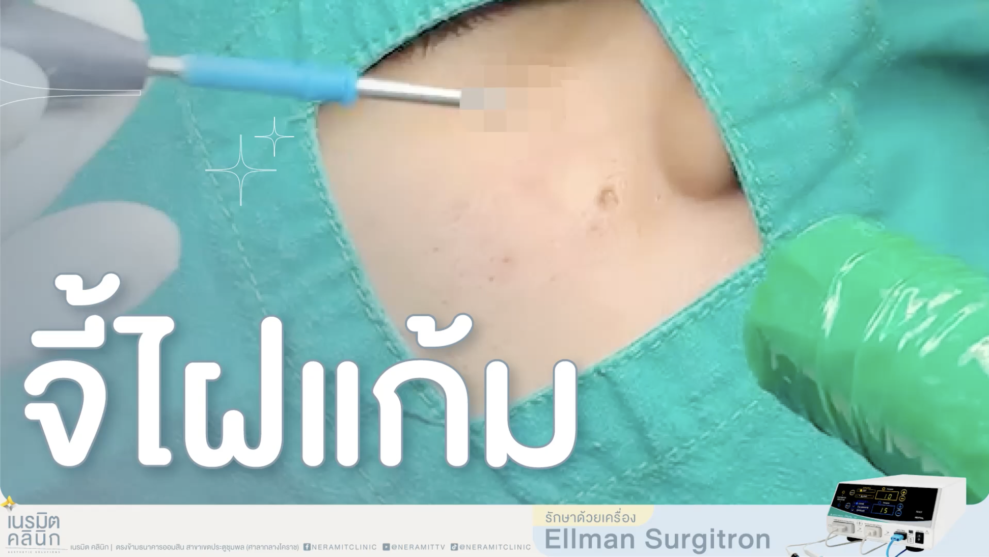 ภาพขั้นตอนการเตรียมและรักษาด้วยการจี้ไฝแก้ม โดยใช้เครื่อง Ellman Surgitron ที่เนรมิตคลินิก