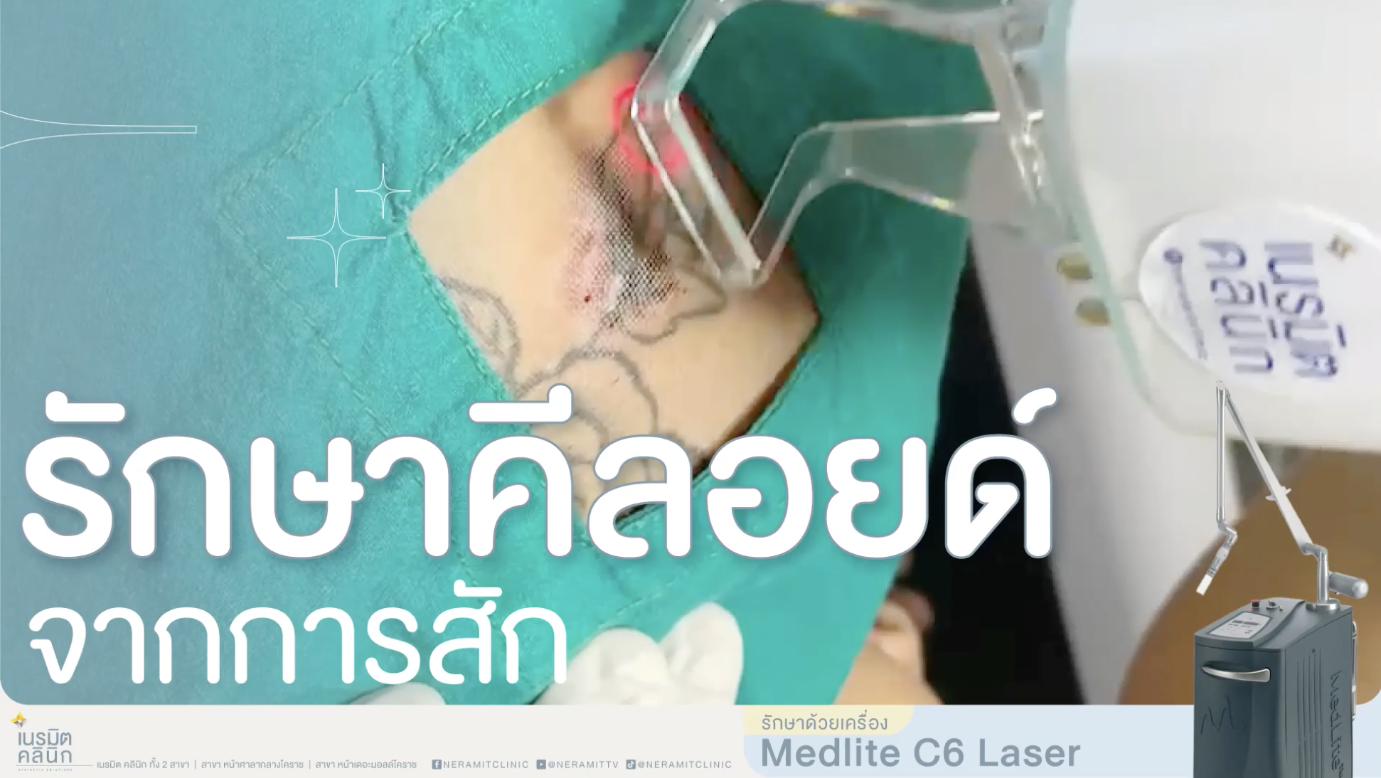 รีวิวภาพการรักษาแผลเป็นนูนหรือคีลอยด์ที่เกิดจากการสัก ด้วยการใช้เครื่องเลเซอร์ Medlite C6 ควบคู่กับการฉีดยา