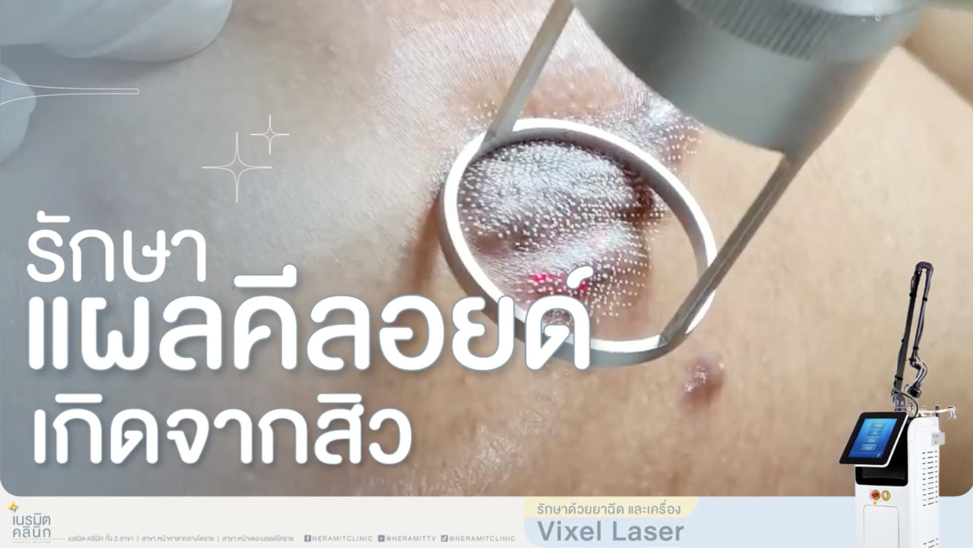 รีวิวภาพการรักษาแผลคีลอยด์เกิดจากสิวบริเวณแผ่นหลัง ด้วยการใช้เครื่อง Vixel Laser ควบคู่กับการฉีดยาที่เนรมิตคลินิก