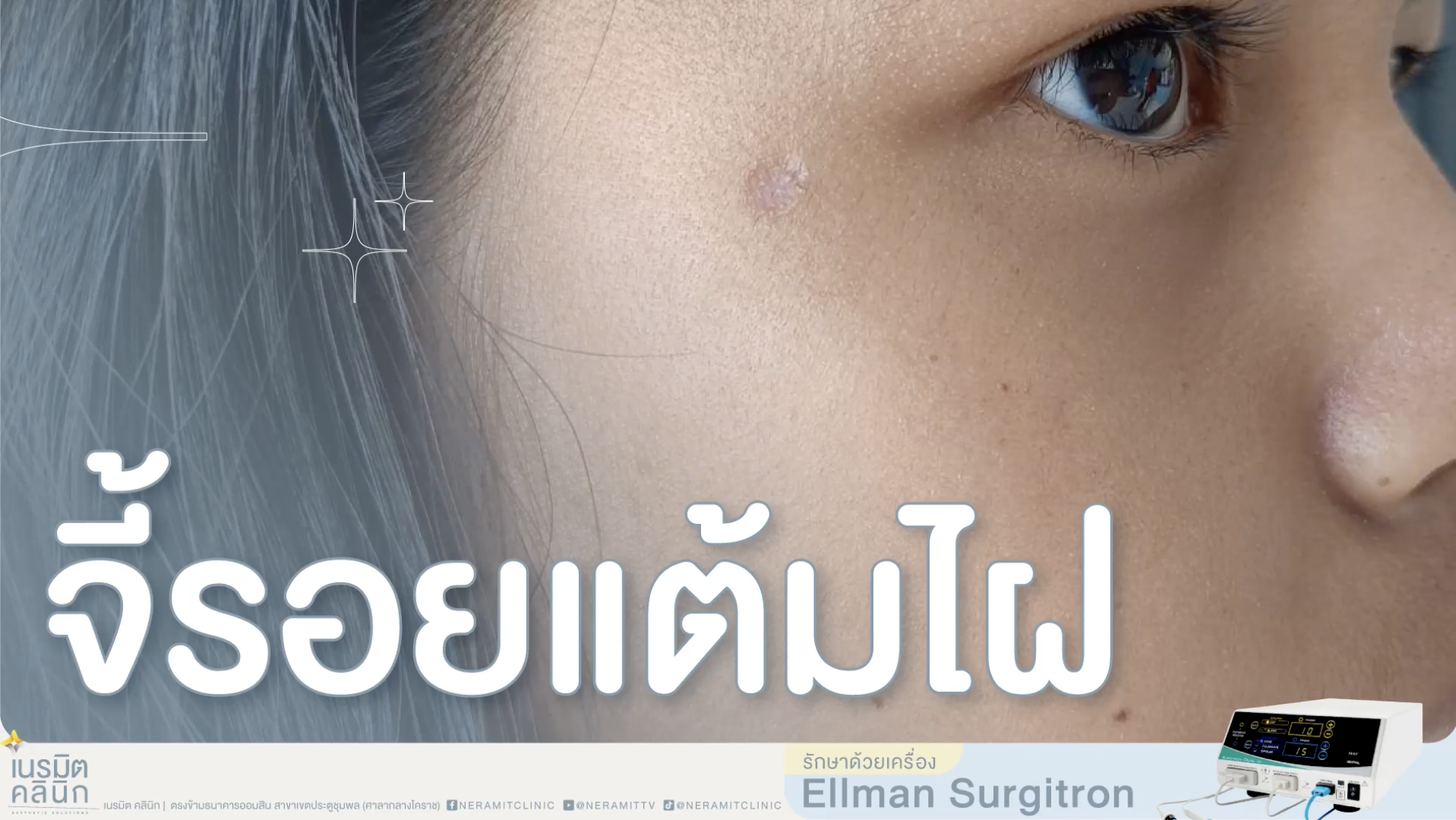 ภาพรีวิวลักษณะของรอยแผลเป็นบริเวณแก้มที่เกิดจากการแต้มไฝ เตรียมเข้ารับการรักษาด้วยเครื่อง Ellman Surgitron ที่เนรมิตคลินิก