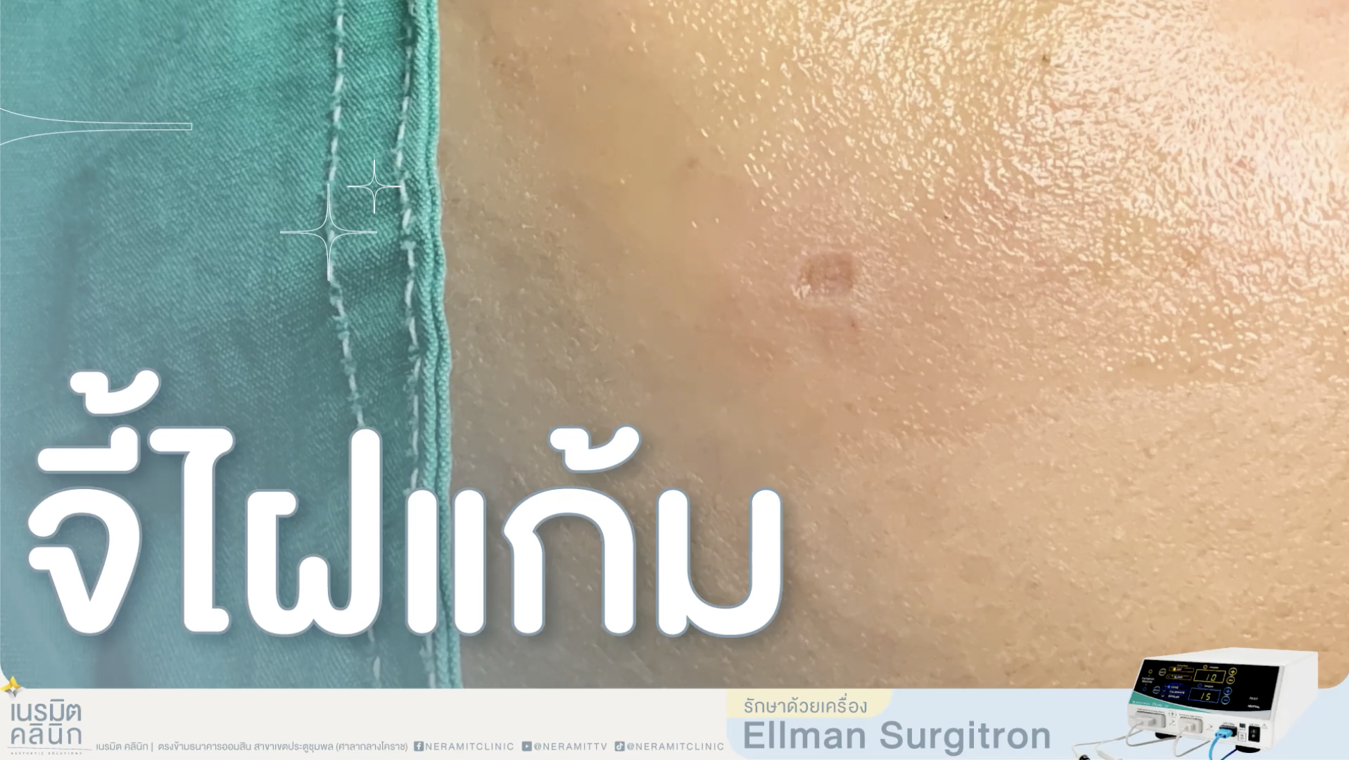ภาพรีวิวการรักษาจี้ไฝแก้มด้วยเครื่อง Ellman Surgitron ช่วยตัดรากไฝอย่างแม่นยำที่เนรมิตคลินิก