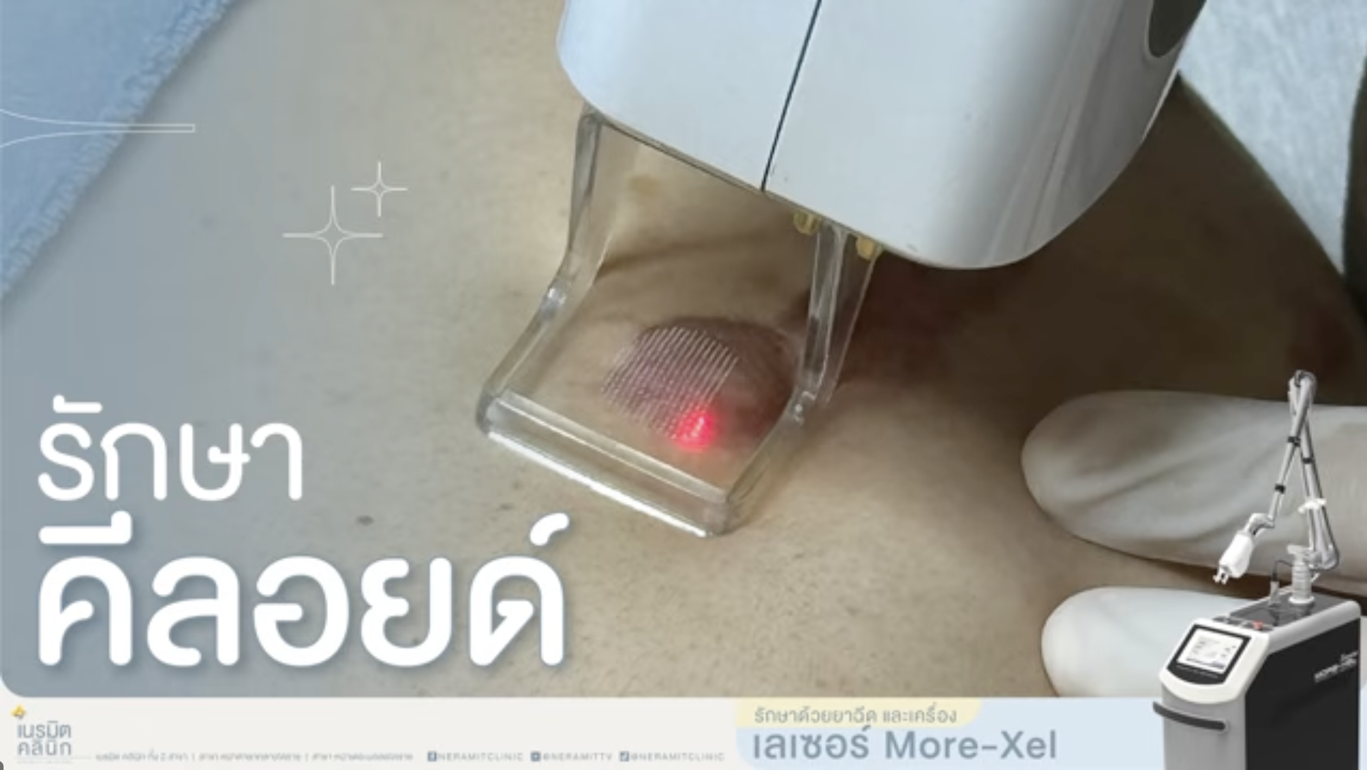 รีวิวภาพขั้นตอนการรักษาแผลคีลอยด์ด้วยการใช้เครื่องเลเซอร์ More-Xel (Fractional CO2) เพื่อปรับสภาพผิวให้เรียบเนียนที่เนรมิตคลินิก